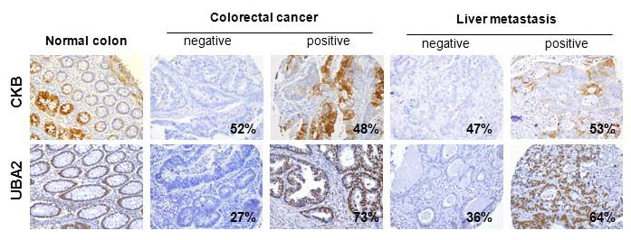 Estudio del papel de diferentes miARNs en la metástasis de cáncer colorrectal