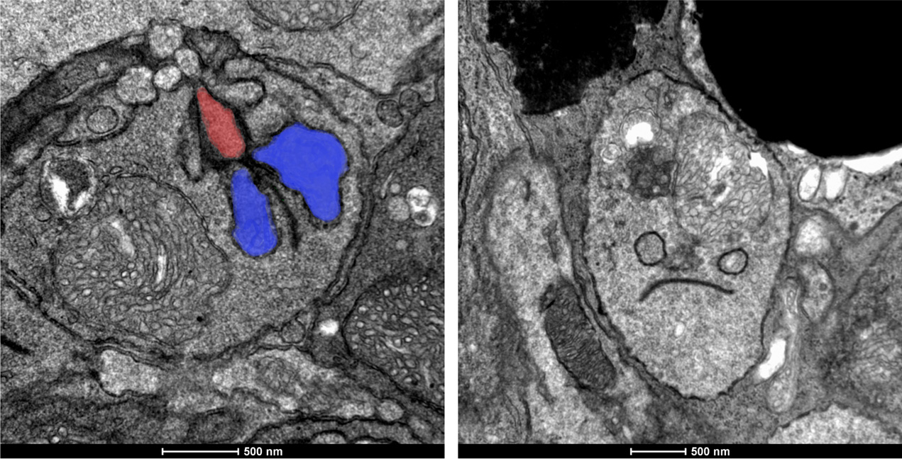 The left image shows a rod synapse containing the postsynaptic contacts colored in blue and red in the healthy retina. The right image shows a disconnected rod of the Retinitis Pigmentosa retina. imagen