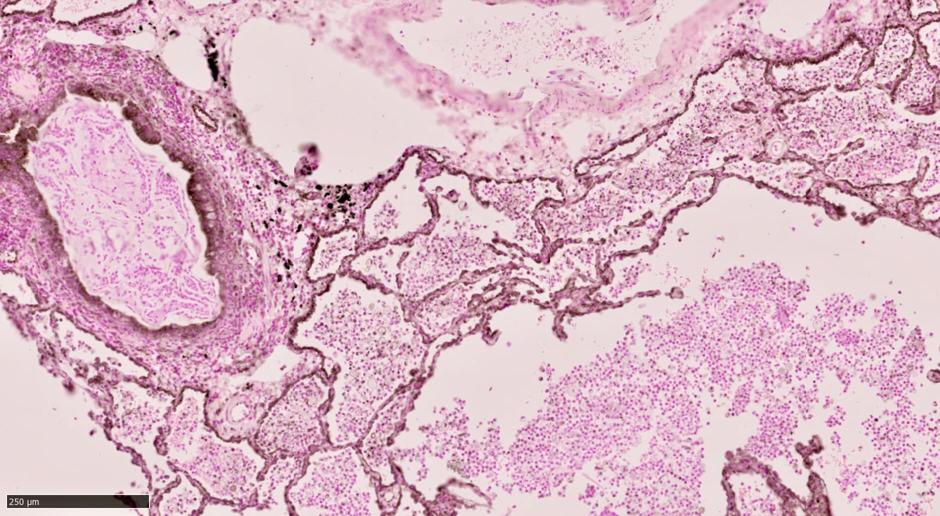 Pulmón de paciente con Hipertensión Pulmonar. En marrón se resalta la proteína mitocondrial MCJ sobreexpresada [Santamans et al. Sci Adv 2024].