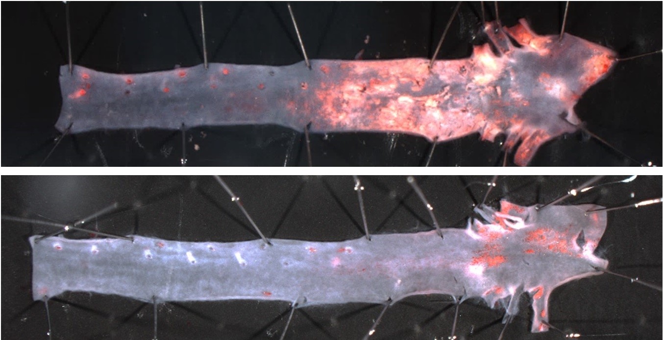 The development of exacerbated atherosclerosis in the aorta of progeroid mice (top image) is prevented by removing progerin in vascular smooth muscle cells (bottom image).