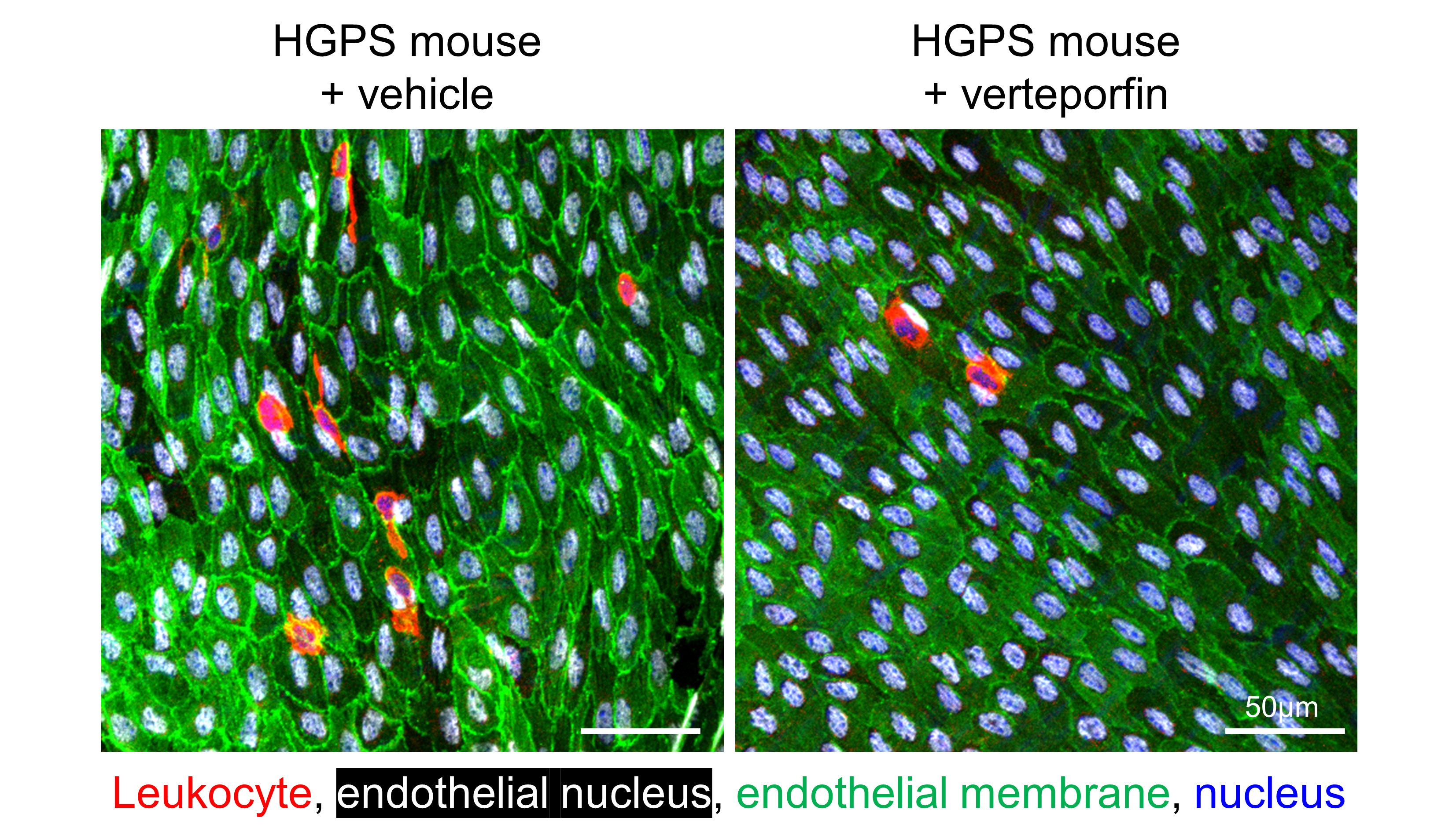 Immunofluorescence of the arterial lumen of aortas from Hutchinson-Gilford progeria syndrome (HGPS) mice treated with vehicle or verteporfin. Endothelial cells are seen in green and white, and leukocytes accumulated in the arterial wall in red.