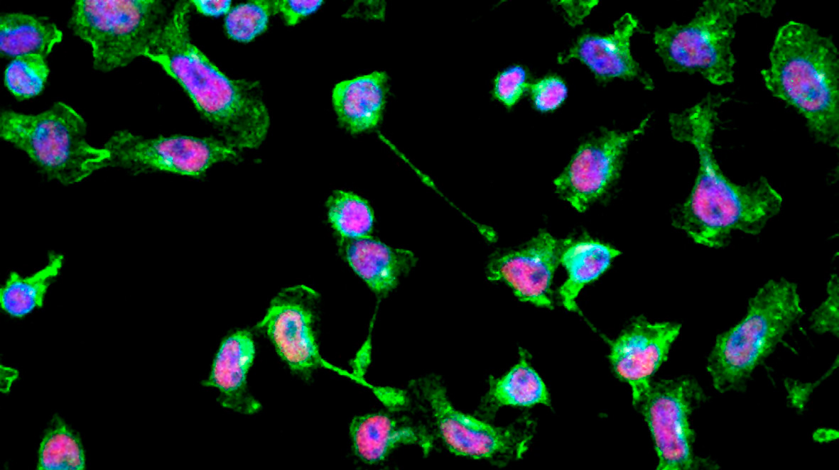 ALL cells treated with a pharmacological inhibitor against LSD1 show a highly elongated morphology corresponding to a more invasive phenotype. ALL cells treated with a pharmacological inhibitor against LSD1 show a highly elongated morphology corresponding to a more invasive phenotype.
