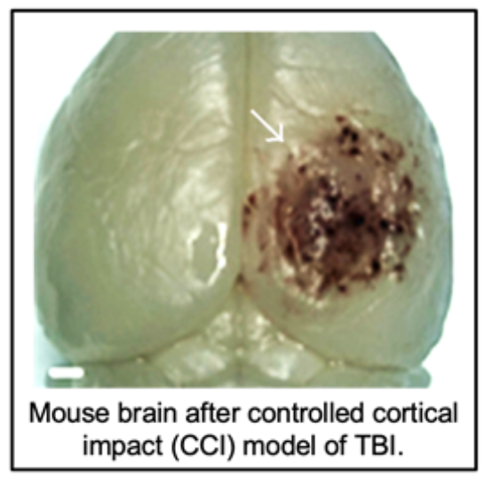 TBI