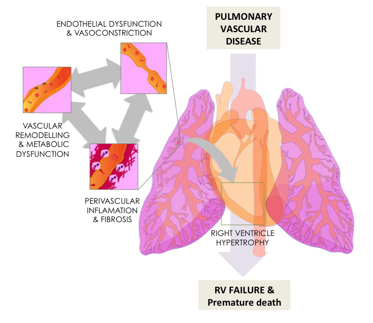 pulmonary vascular disease
