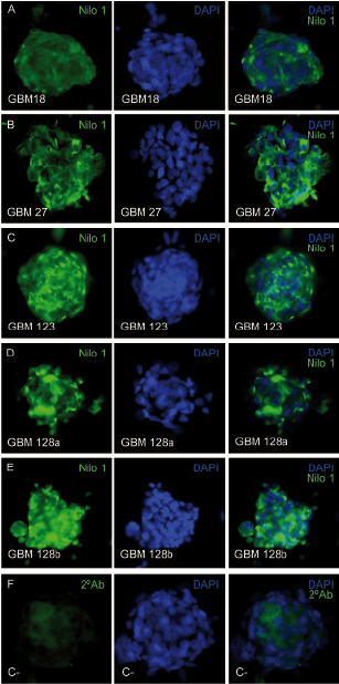 Nilo1 expression in human glioblastomas