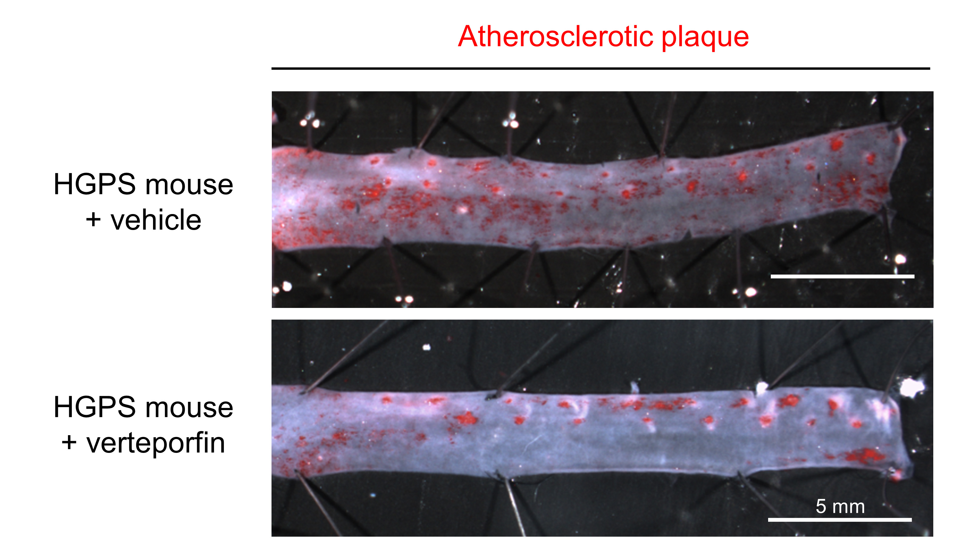 Oil Red O staining of aortas from Hutchinson-Gilford progeria syndrome (HGPS) mice treated with vehicle or verteporfin. Lipids present in atherosclerotic plaques are shown in red.